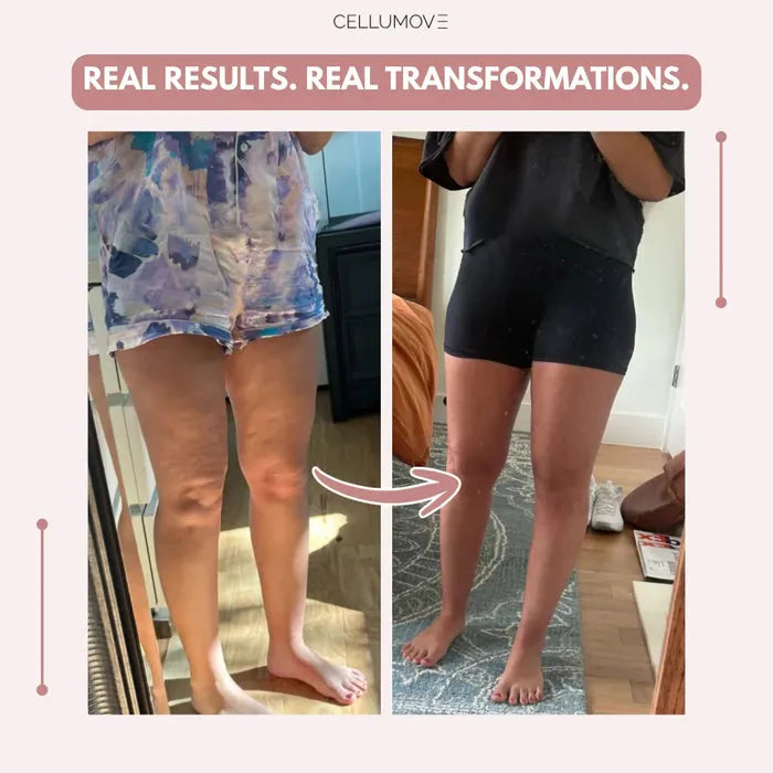 Cellumove 3D legging - say goodbye to lipedema pain and swelling naturally