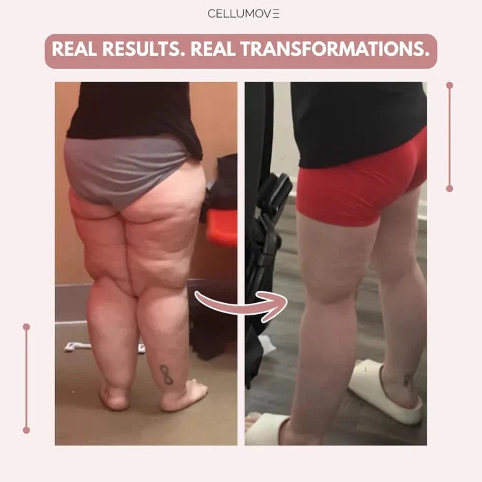 Cellumove 3D legging - say goodbye to lipedema pain and swelling naturally