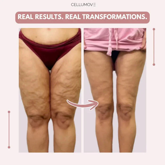Cellumove 3D legging - say goodbye to lipedema pain and swelling naturally