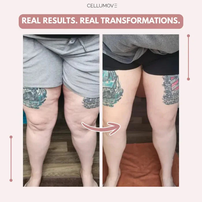Cellumove 3D legging - say goodbye to lipedema pain and swelling naturally